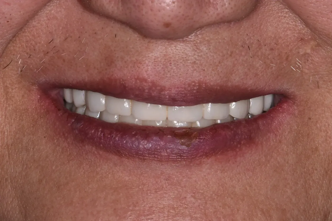 Full-mouth rehabilitation — after treatment