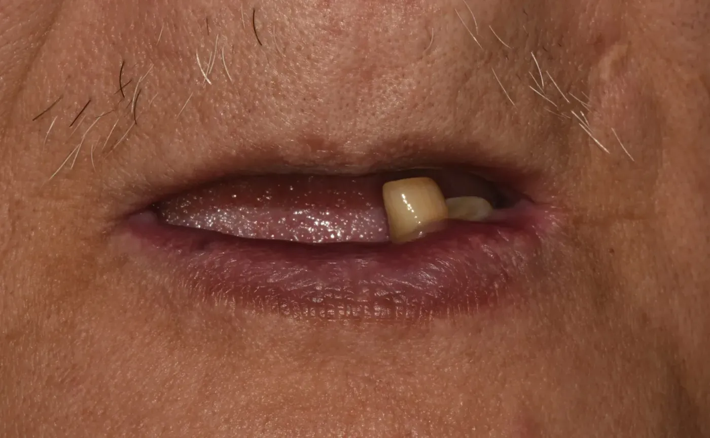 Full-mouth rehabilitation — before treatment