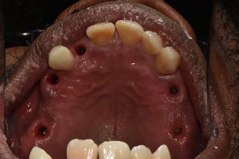 Upper arch implant treatment (view from below) — before treatment