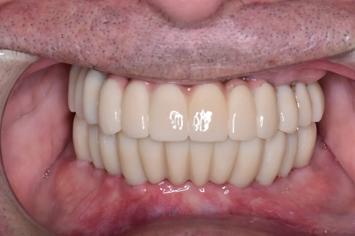 Upper full-arch implant restoration — after treatment