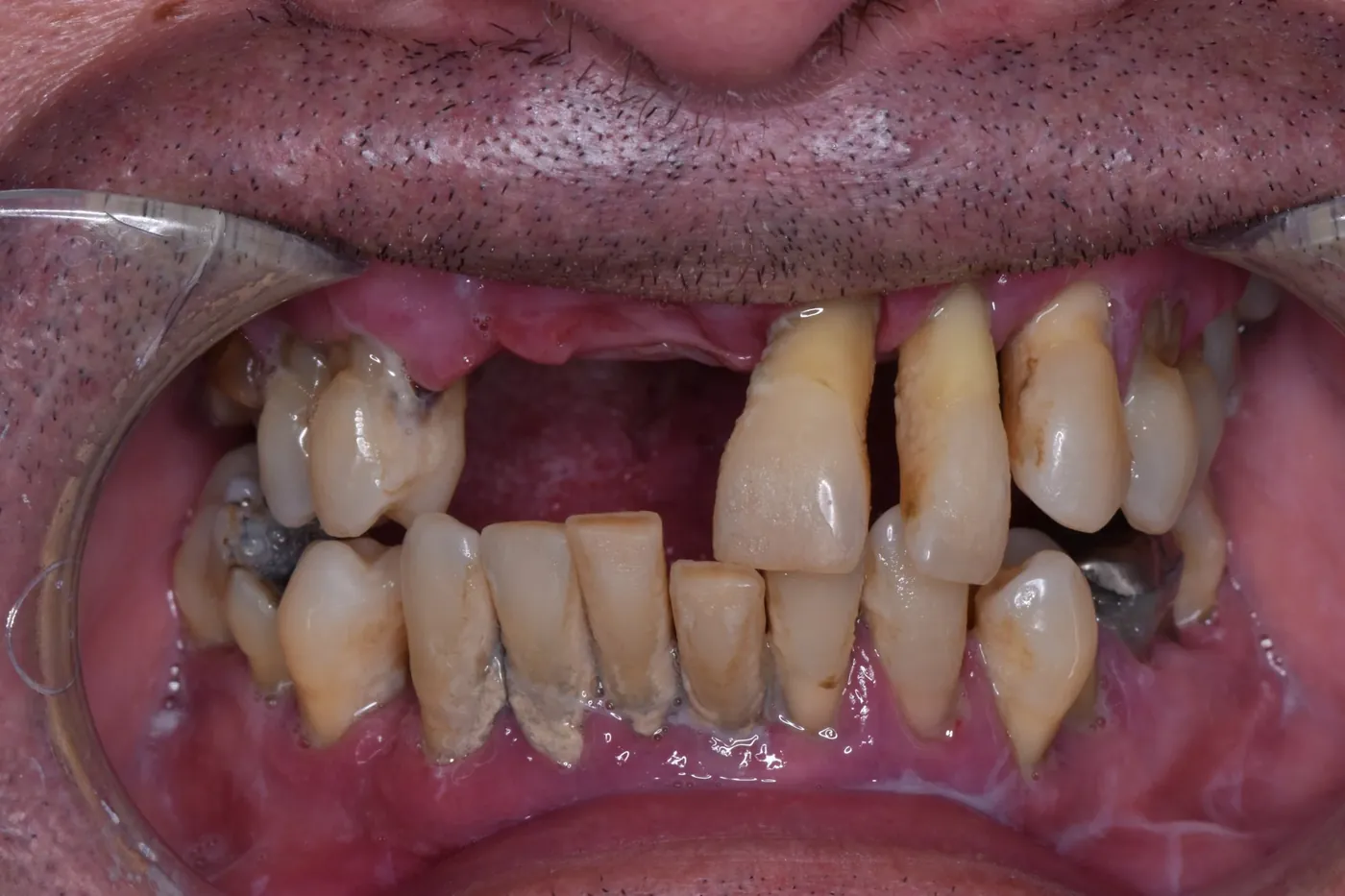 Upper full-arch implant restoration — before treatment