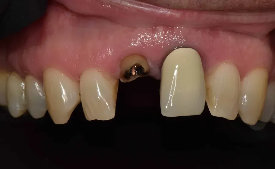 Front teeth restoration with ceramic crowns — before treatment