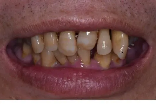 Full-arch smile rehabilitation — before treatment