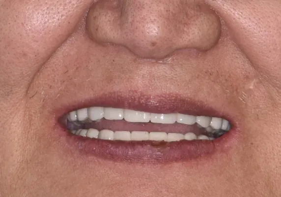 Full-arch restoration — no remaining upper teeth — after treatment