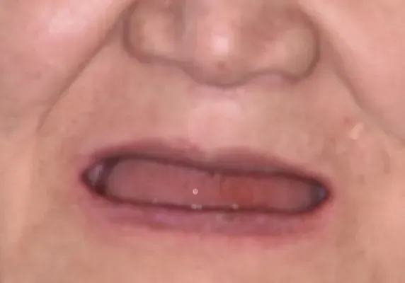 Full-arch restoration — no remaining upper teeth — before treatment