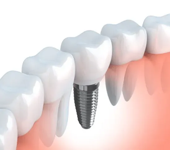 Illustration of a dental implant supporting a crown