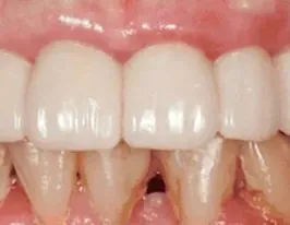 Example of an FP1 full-arch bridge
