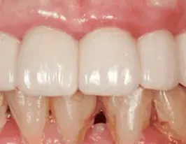 FP1 full-arch bridge, front teeth
