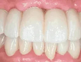 FP1 full-arch bridge, natural gum line