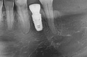 Dental X-ray showing bone around an implant