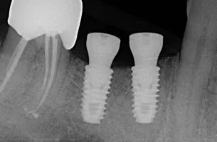 X-ray of two implants supporting a bridge