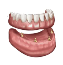 Illustration of an implant-retained overdenture