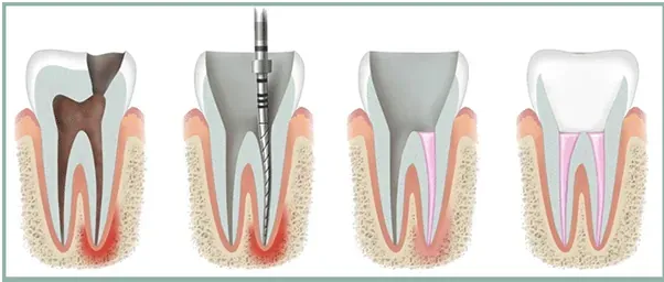 Illustration of the stages of root canal treatment