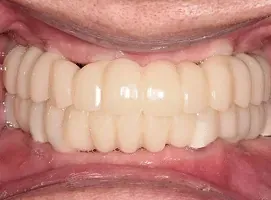 Temporary FP1 bridge after surgery