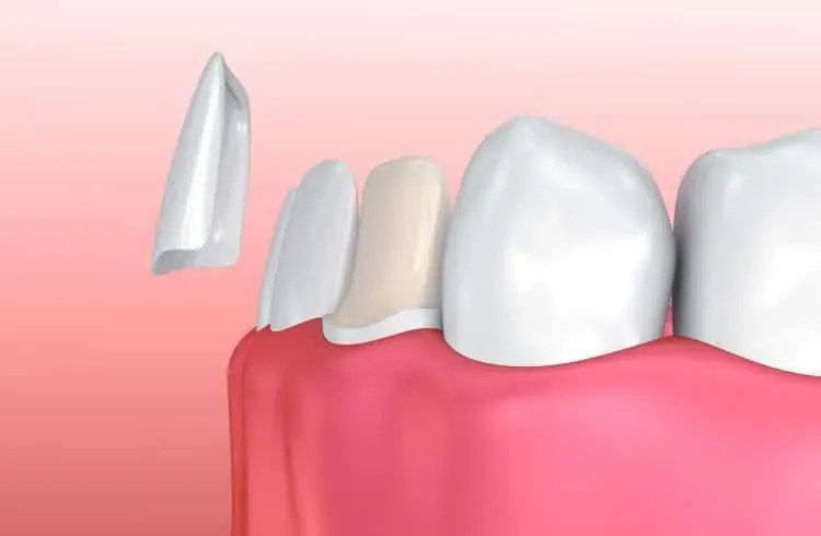 Illustration of a veneer being placed on a tooth