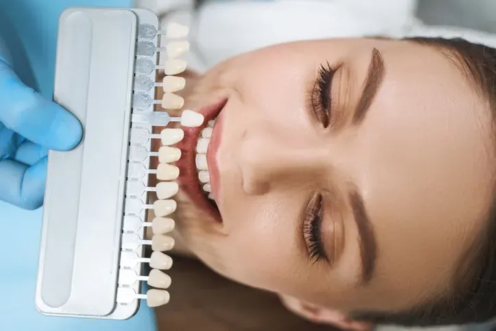Shade matching for porcelain veneers